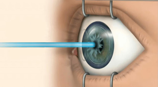 Можно ли вернуть зрение при близорукости операция